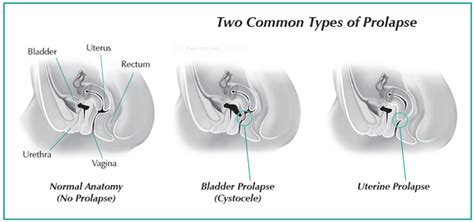 Pelvic Organ Prolapse Women S International Pharmacy