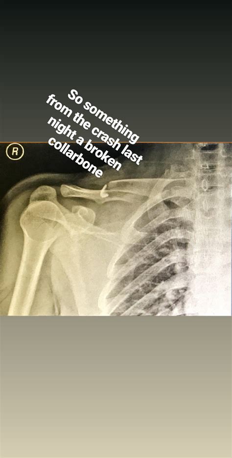 I Had A Collarbone Fracture While Riding To Train For A Race It Quite