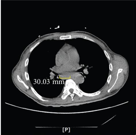 Ct Of The Chest Abdomen And Pelvis A Axillary Lymphadenopathy B