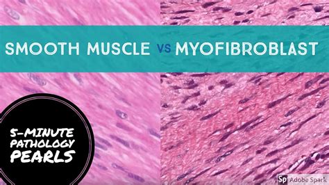 Myofibroblasts Vs Smooth Muscle Made Easy 5 Minute Pathology Pearls