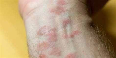 Rash On Arm Causes Itchy Red Treatments And Remedies
