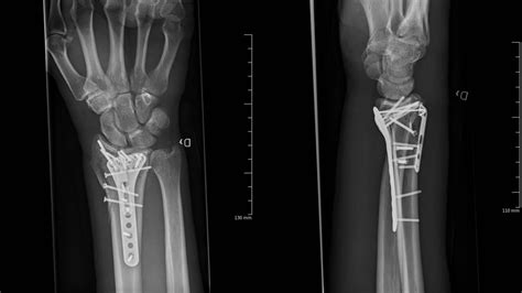 Want To Learn How To Manage A Distal Radius Fracture From Start To