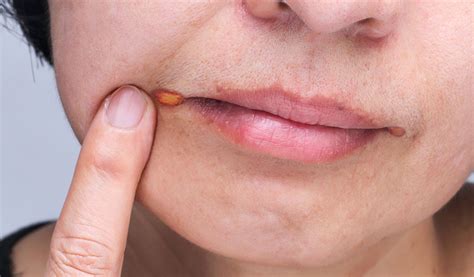 6 Things To Know About Angular Cheilitis And Tiege Hanley