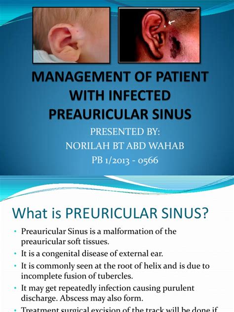 Preauricular Sinus Wound Surgery