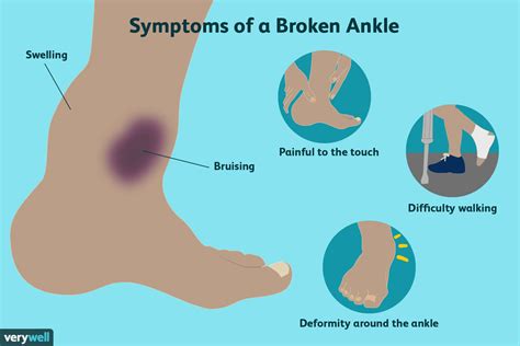 Symptoms of a broken ankle and a sprained ankle are very similar. Most Common Types of Ankle Fractures