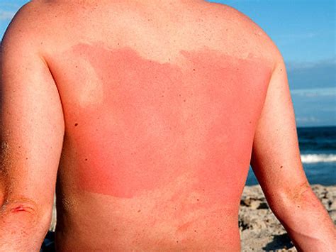 Sloughing Of Skin Radiation Sickness 8 Terrifying Symptoms Cbs News