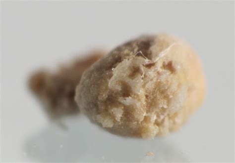 4 Millimeter Kidney Stone Prnso