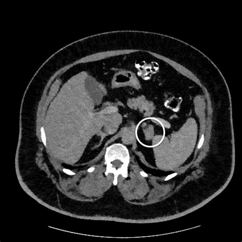 Two Left Adrenal Masses In A 62 Year Old Man Renal And Urology News