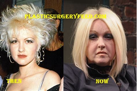 Cyndi Lauper Plastic Surgery Plastic Surgery Feed