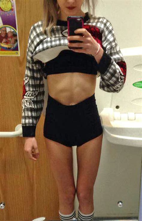 Dancer Who Battled Anorexia Reveals Incredible Recovery Pictures And