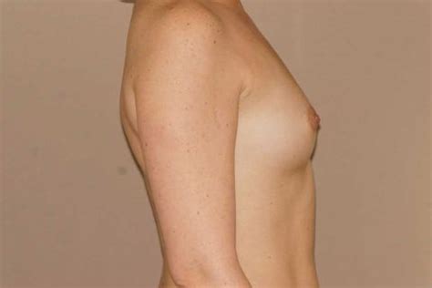 Brustvergr Erung Vorher Und Nachher Bilder Brustimplantate Silikon