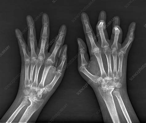 Rheumatoid Arthritis Of The Hands X Ray Stock Image C0370767