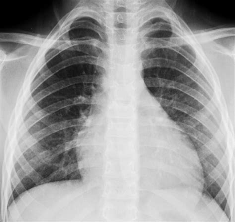 Mycoplasma Pneumoniae Induced Rash And Mucositis A Recently Described