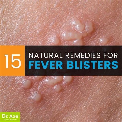 Perfect Medication For Fever Blisters On Lips And View Fever Blister