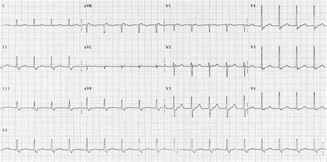 Paroxysmal supraventricular tachycardia (psvt) is episodes of rapid heart rate that start in a part of the heart above the ventricles. Psvt Ecg - Supraventricular Tachycardia Svt Acls ...