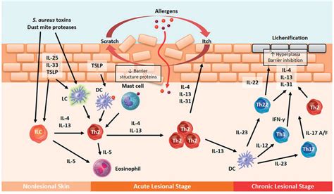 Skin Barrier Dysfunction And Immune Response In Atopic Dermatitis Ad