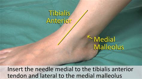 Musculoskeletal Examination And Joint Injection Series Ankle Joint