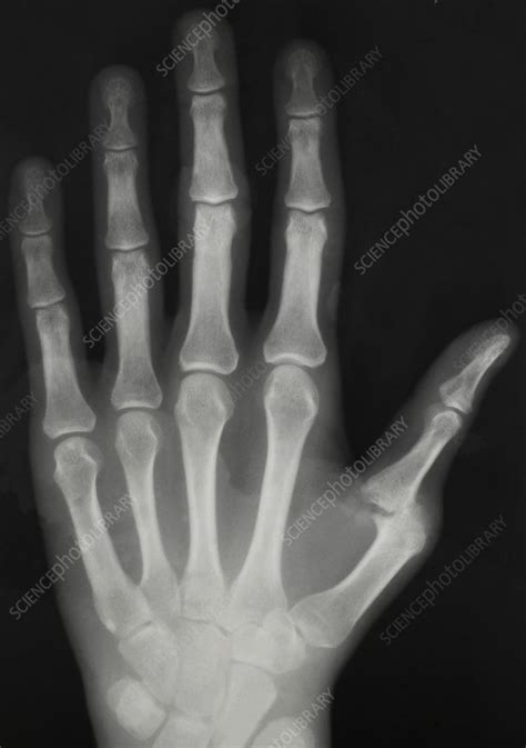 Arthritic Hand X Ray Stock Image M1100676 Science