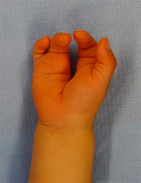 Cleft Hand Surgery Congenital Hand And Arm Differences Washington