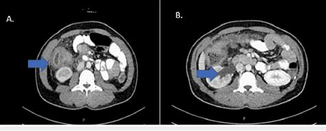 A Inflammatory Mass Closely Attached To The Ascending Colon With