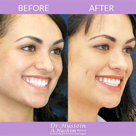 Dimple Creation Lebanon Dimpleplasty Dr Hussein Hashim