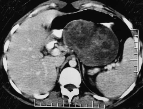 Pancreatic Cystic Lesion In The Tail Of Pancreas In A Male Patient Aged