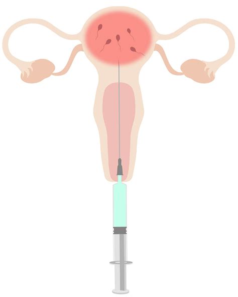 Intrauterine Insemination Iui Reproductive Fertility Center