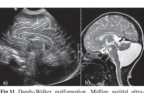 Figure 9 From Neonatal Head Ultrasound Systematic Approach To