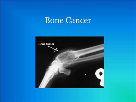 Ppt Bone Cancer Powerpoint Presentation Free Download Id1973116