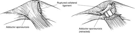Pdf Injuries To The Ulnar Collateral Ligament Of The Thumb