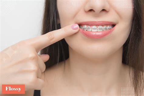 How Much Do Braces Cost With And Without Insurance