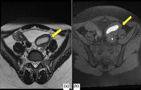 Mri Of The Pelvis A Axial T2wi Demonstrating Uterus Didelphys With