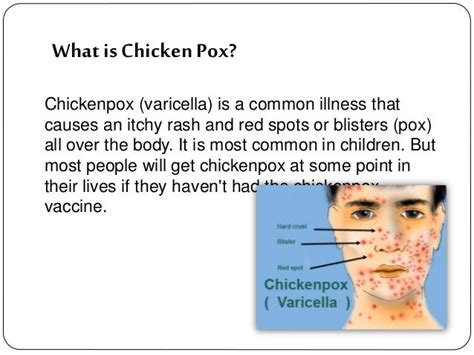 10 Home Remedies For Chickenpox Itching Top 20 Home Remedies