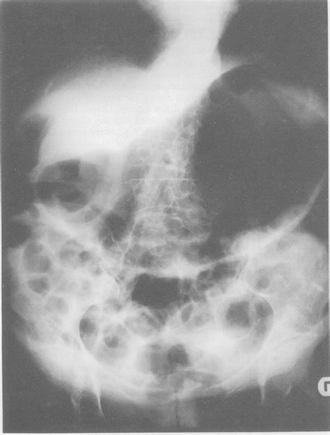 X Ray Ofabdomen Showing Massive Gastric Dilatation With Percutaneous