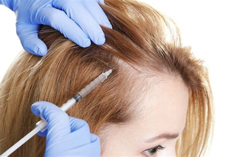 Alopecia En Mujeres Estos Son Los Mejores Tratamientos Para Evitarla