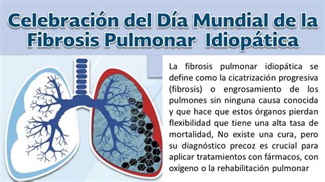 Fibrosis Pulmonar Idiopática Hot Sex Picture