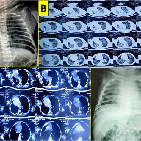 A Chest Radiography Of Left Infantile Lobar Emphysema With Left