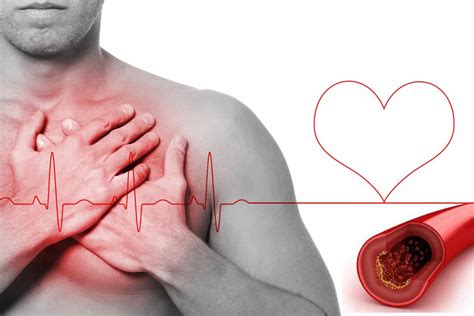 Infarto agudo al miocardio causas síntomas y tratamietno La Guía de las Vitaminas
