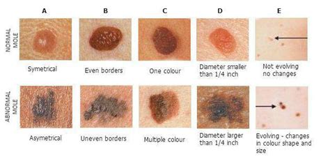 Abcdefs Of Changing Moles And Melanoma