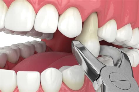 Common Signs You May Need A Tooth Extraction Sonoran Desert Dentistry Scottsdale Arizona
