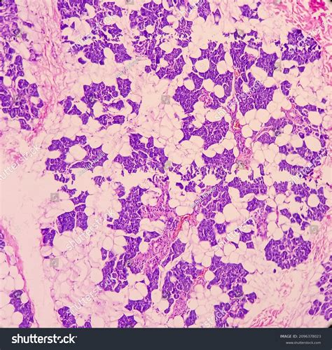 Parotid Tumor Pleomorphic Adenoma Benign Neoplasm Stock Photo Edit Now
