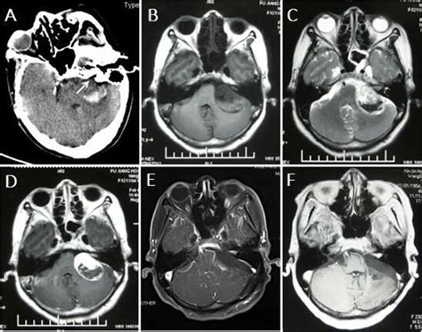 A Ct Scan Showed A Hyperdense Lesion In The Left Cerebellopontine Angle