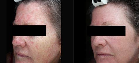 Photodynamic Therapy Skin Alert Cairns Skin Cancer And Cosmetic Clinic