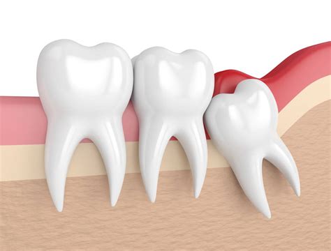 Like your health insurance plan, a dental insurance plan provides benefits that help pay for dental costs. WISDOM TOOTH EXTRACTION - Aspen Dental
