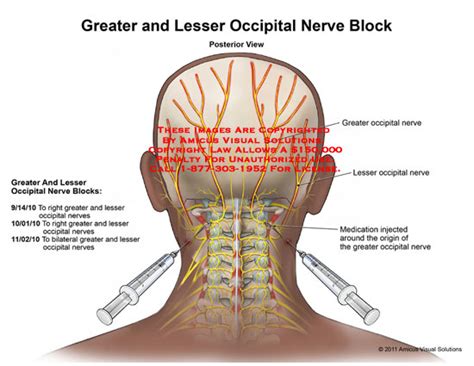 Greater And Lesser Occipital Nerve Block