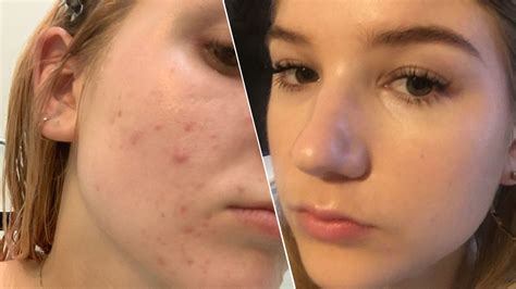 Accutane Side Effects 9 Things To Know About The Acne Treatment Glamour