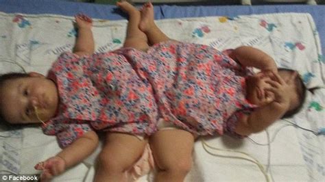 Rare Conjoined Twin Sisters Who Were Born In A Set Of Triplets Head
