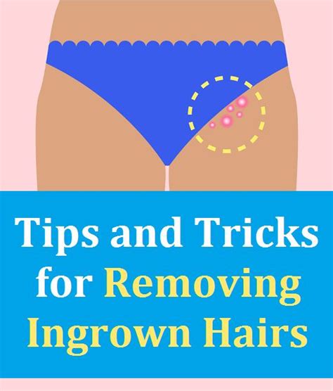Ingrown hairs are most common in areas of hair. Tips and Tricks for Removing Ingrown Hairs on your Bikini ...