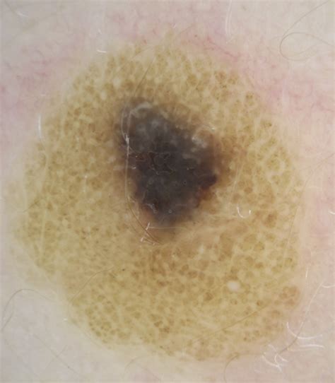 Dermoscopy Of A Clonal Inverted Type A Nevus In A Child Journal Of