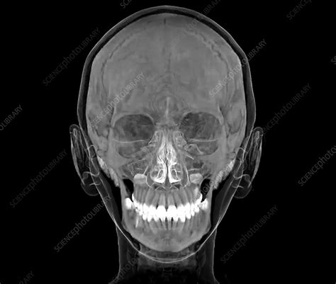 Normal Human Skull 3d Ct Scan Stock Image C0472014 Science